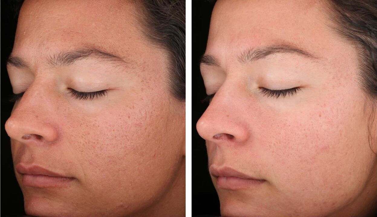 Laser rejuvenation