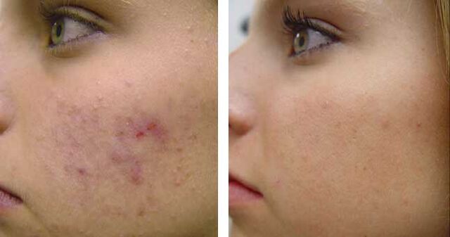 Before and after cryotherapy